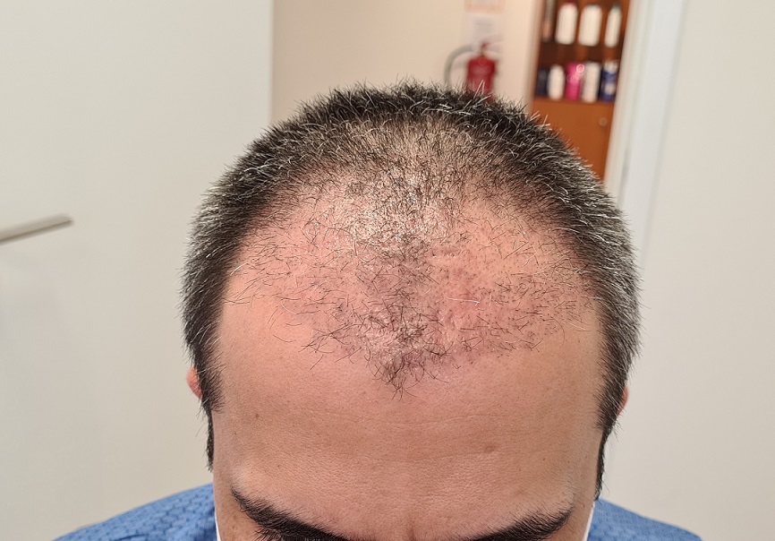 4. 1 month after.jpg
