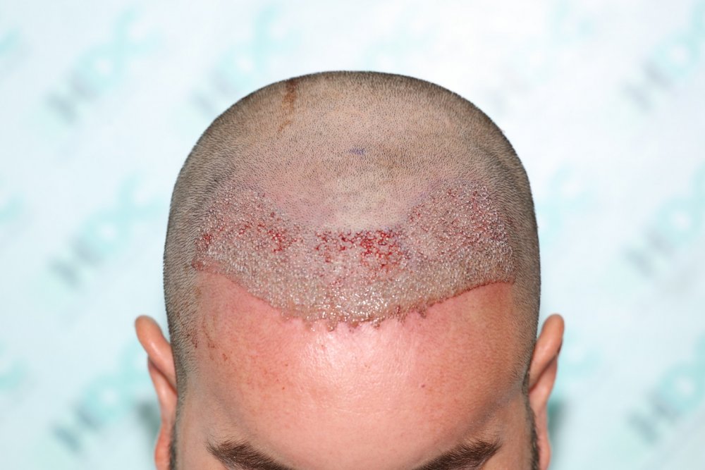 4. 2680 grafts Post op Front.JPG