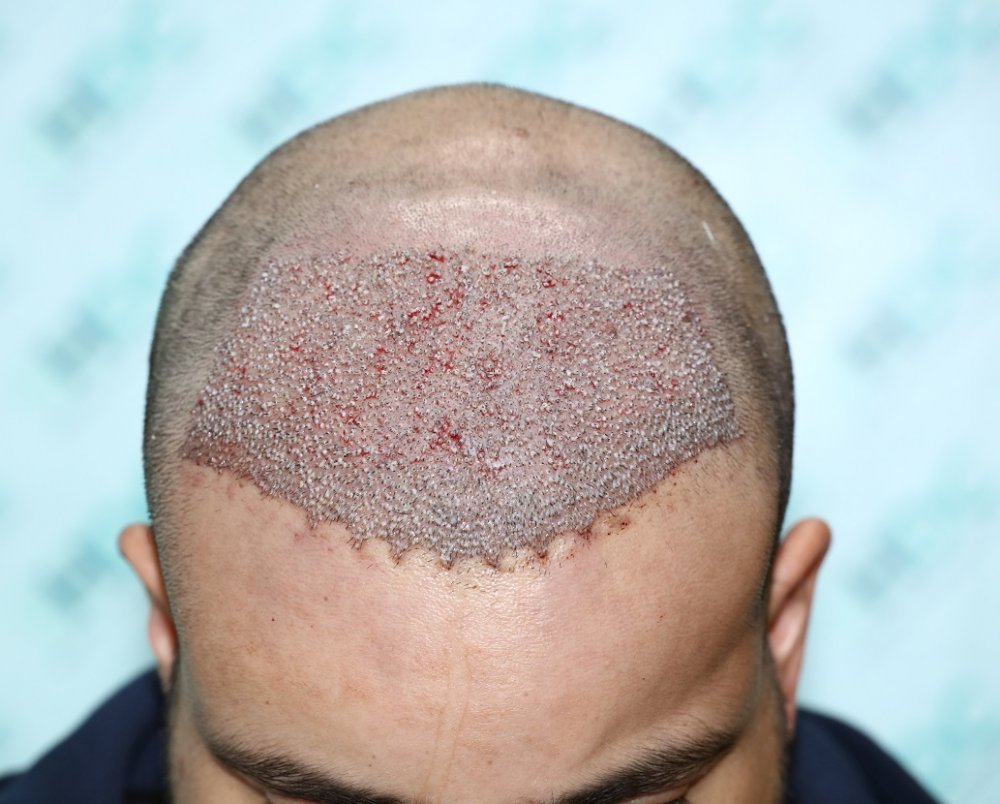 4. 3200 Grafts post op - Top.JPG