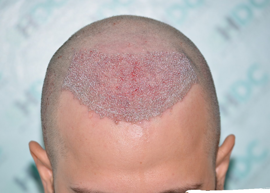4. 3475 grafts.JPG