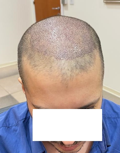 4. 5 days after Front.jpg