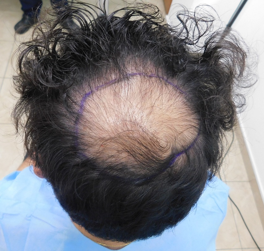 4. Before Crown.JPG