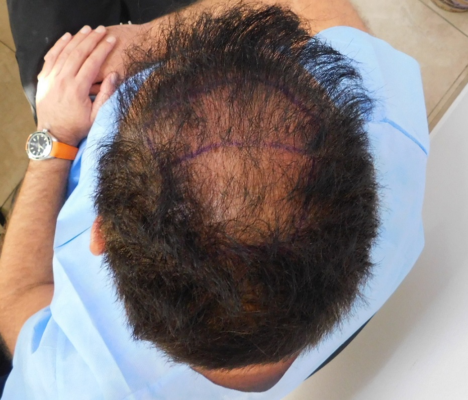 4. Before FUE2 Back View.JPG