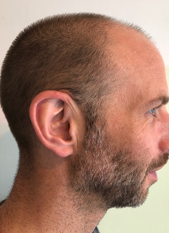 4. Before Side Right Donor.jpg