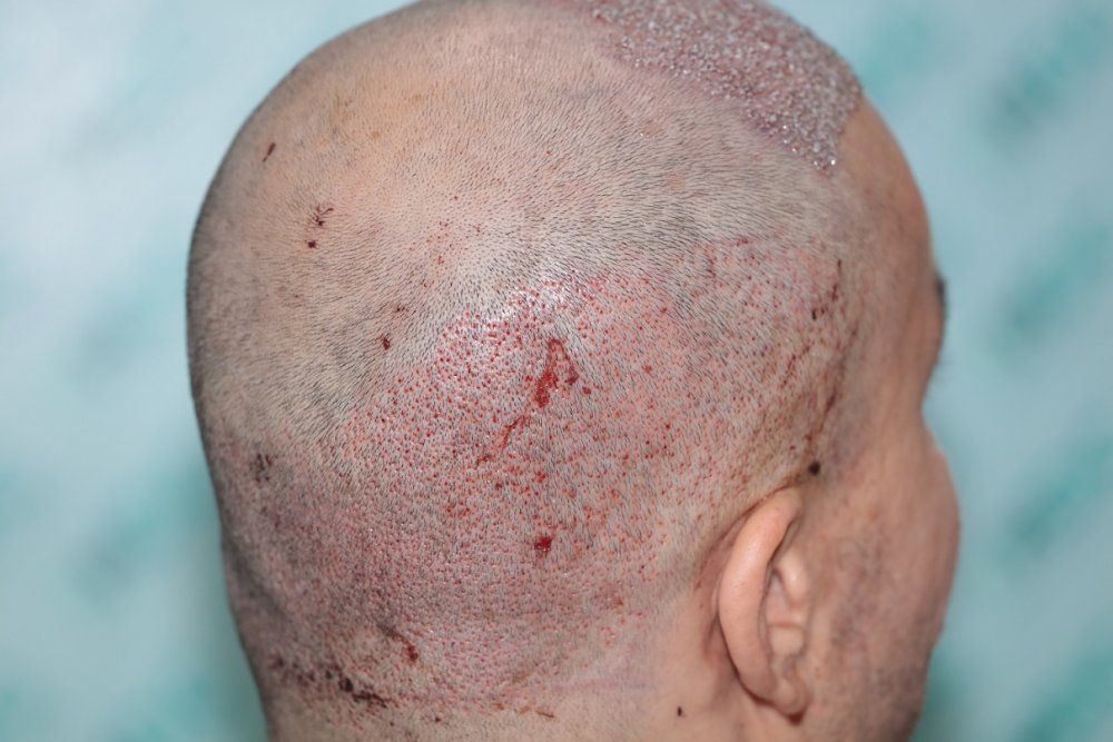4. Donor Post op - Right.JPG