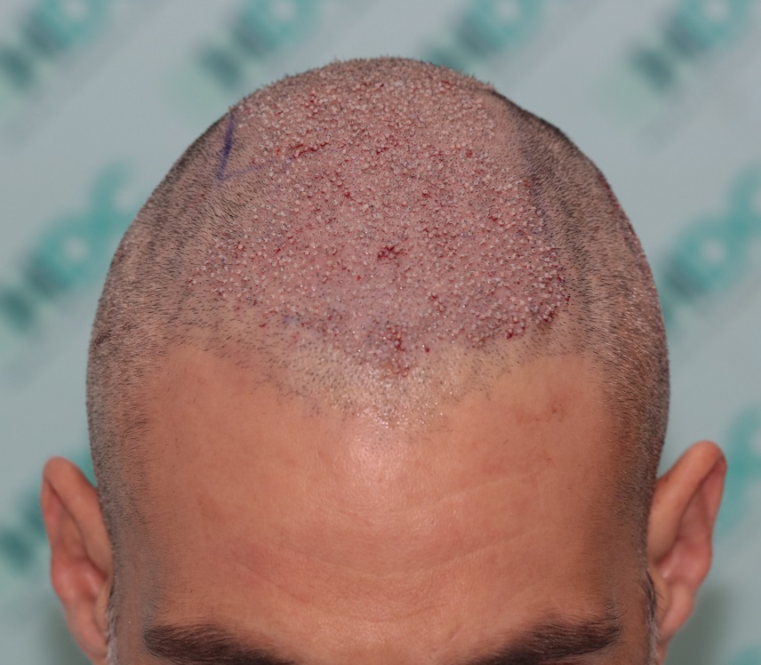 4. Front post op.JPG