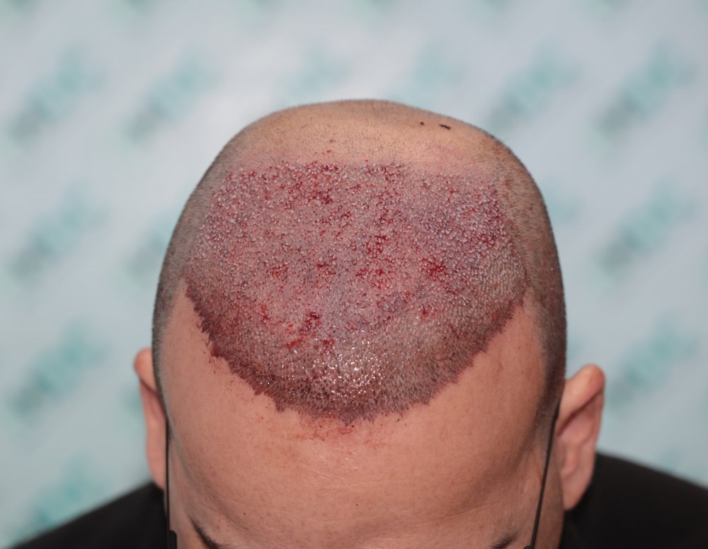 4. FUE1 on 28-02-24 for 4500 Grafts.JPG