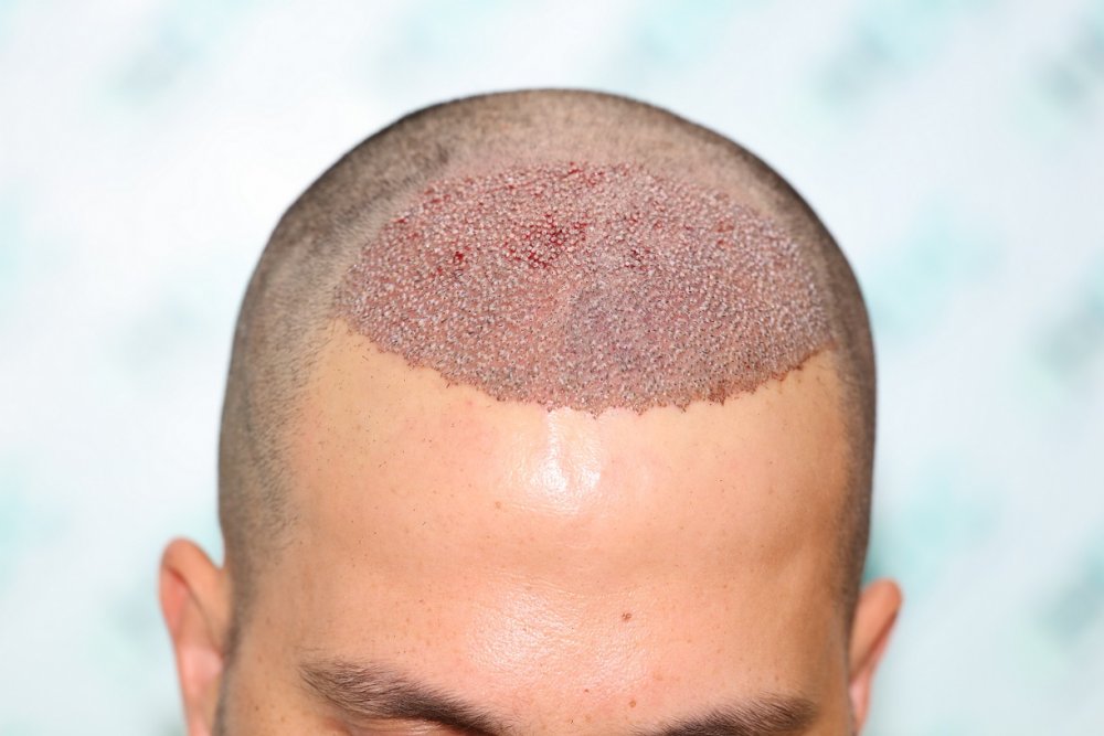 4. Post op 3170 Grafts - front.JPG