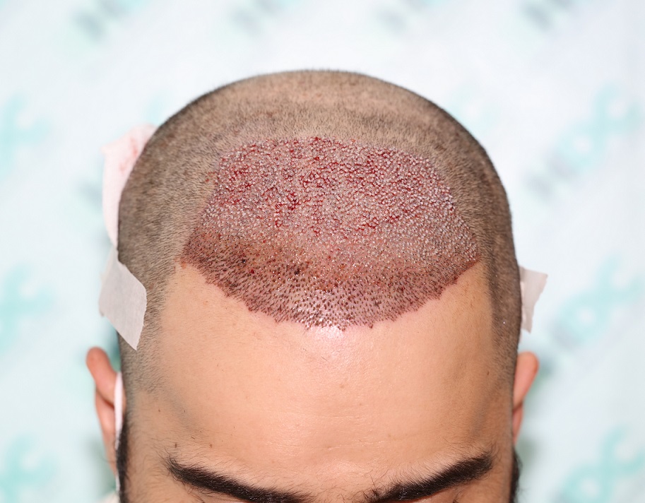 4. Post op 3320 Grafts on 03-06-21.JPG