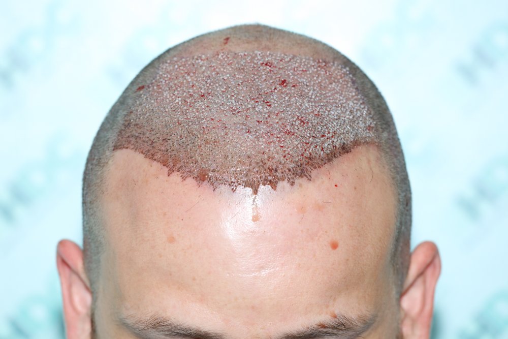 4 - Post op 3670 Grafts.JPG