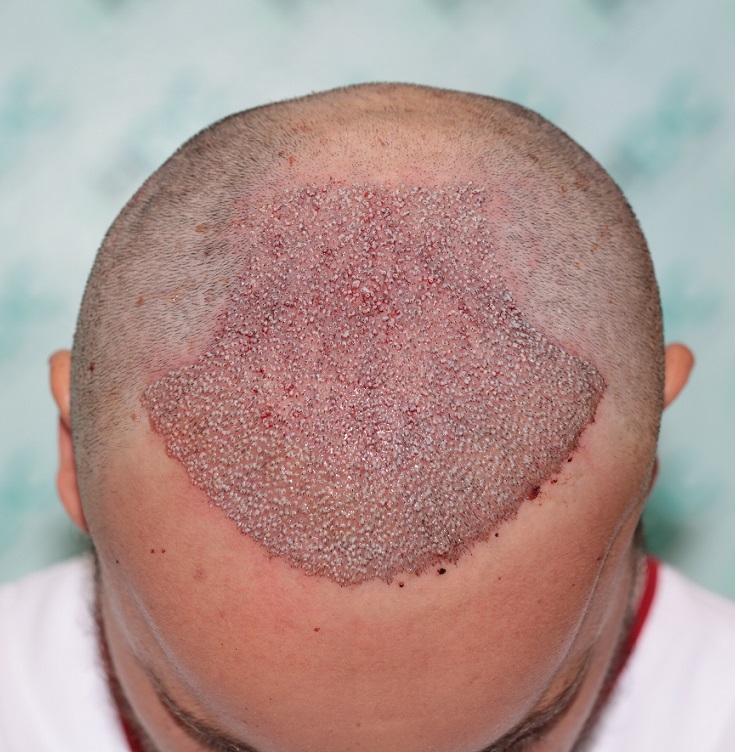 4. Post op 3845 on 30-06-22.JPG