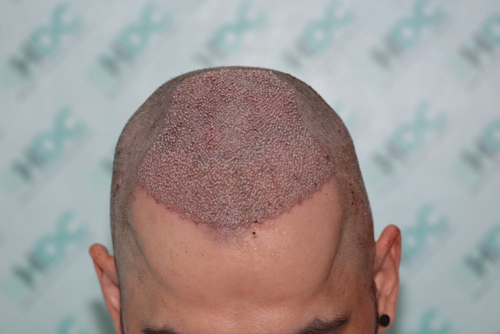 4 post op 4400 Grafts.JPG