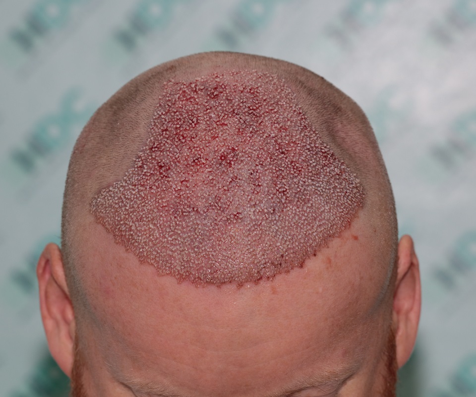 4. Post op 4568 Grafts.JPG