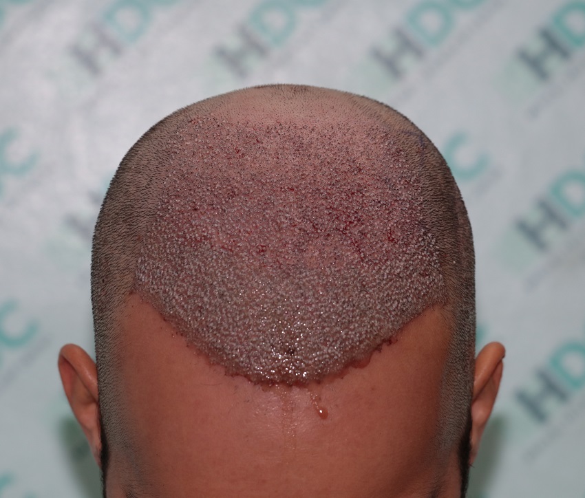 4. Post op 4900 grafts on 23-05-22 - Top.JPG