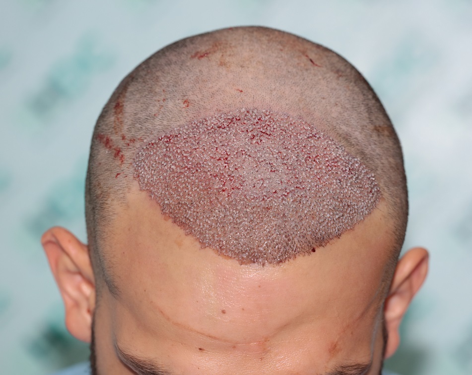 4. Post op Front 3000 Grafts.JPG