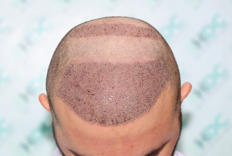 4. Post op Front.JPG