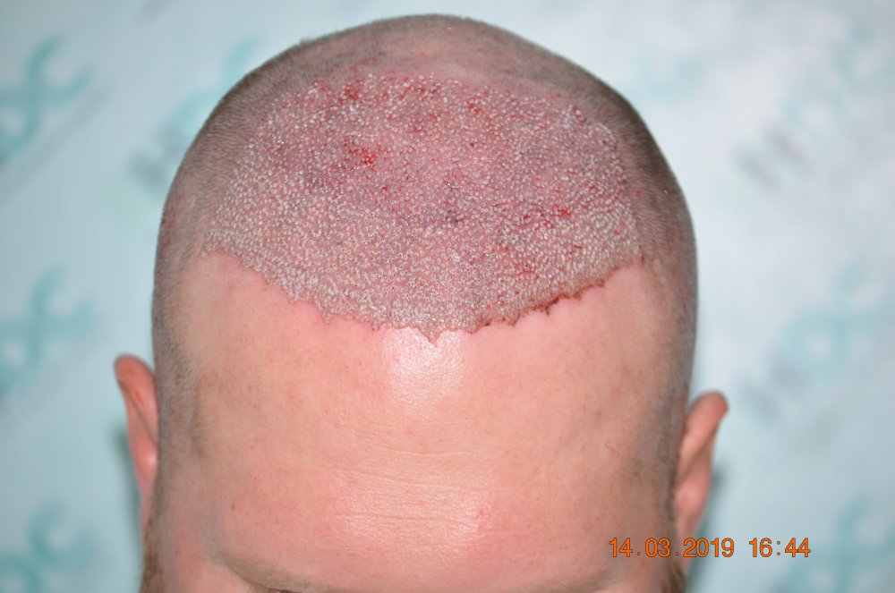 4. Post op FUE1 for 3600 grafts on 14-03-19.JPG