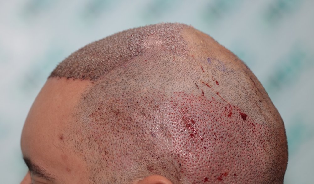 4. Post op Left.JPG