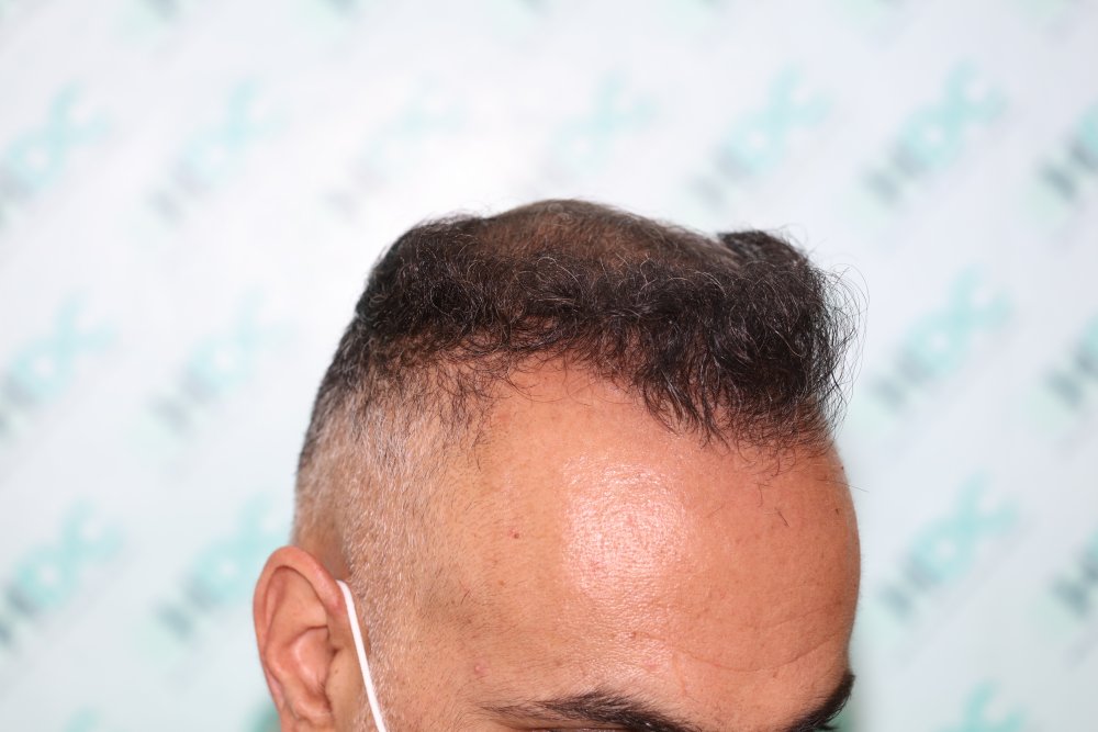 4. result of FUE1.JPG