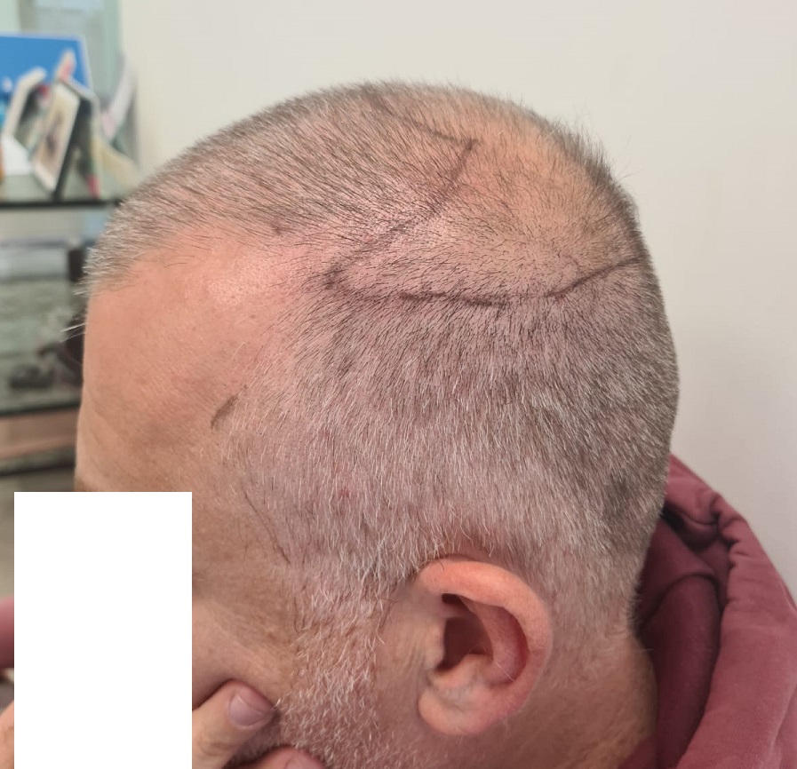 4. Side donor before with short hair..jpg