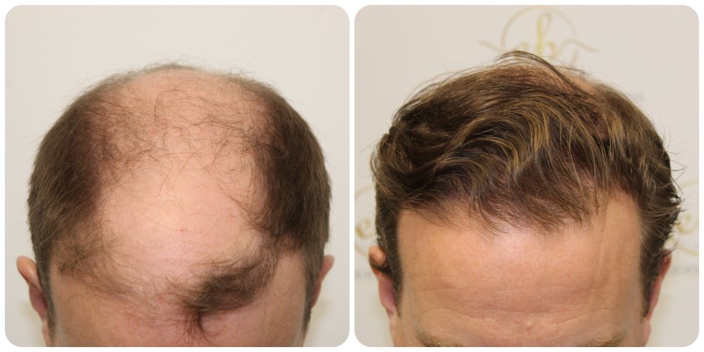 4000-grafts-fue-result-hair-transplant-dr-bonaros-scotland.jpg