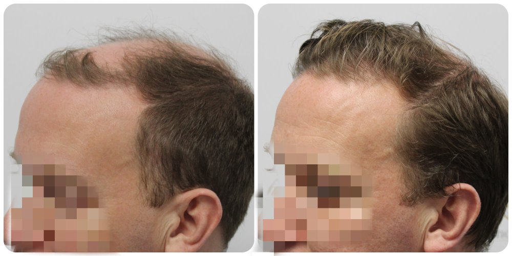 4000-grafts-fue-results.jpg