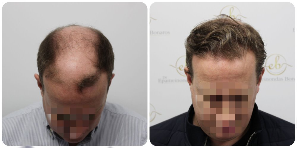 4000-grafts-hair-transplant-result-dr-bonaros-glasgow.jpg