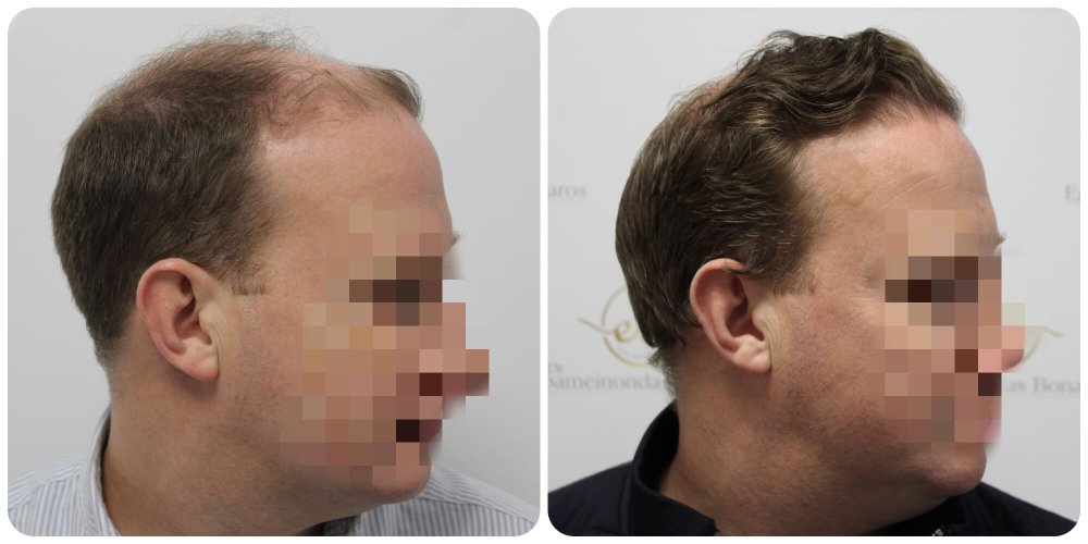 4000 grafts-uk-hair transplant-dr-bonaros.jpg