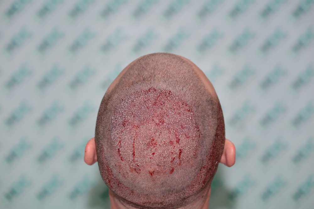 4a - 3700 grafts for crown.JPG