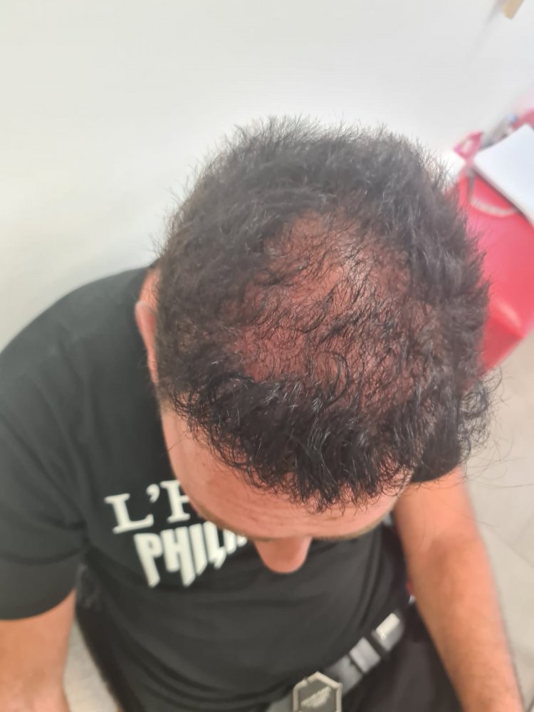 4a. Before FUE2 - Top view.jpg