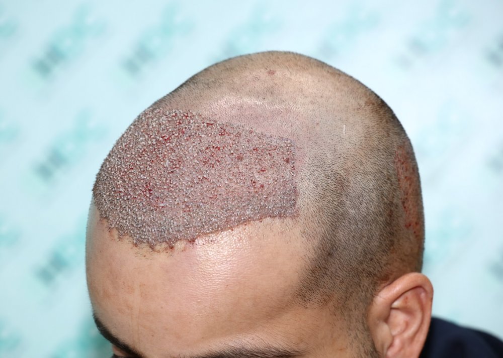 5. 3200 Grafts post op - Left Top.JPG