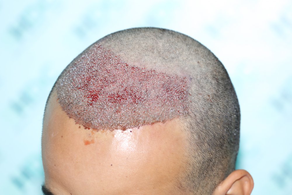 5. 3200 grafts - slight Left.JPG