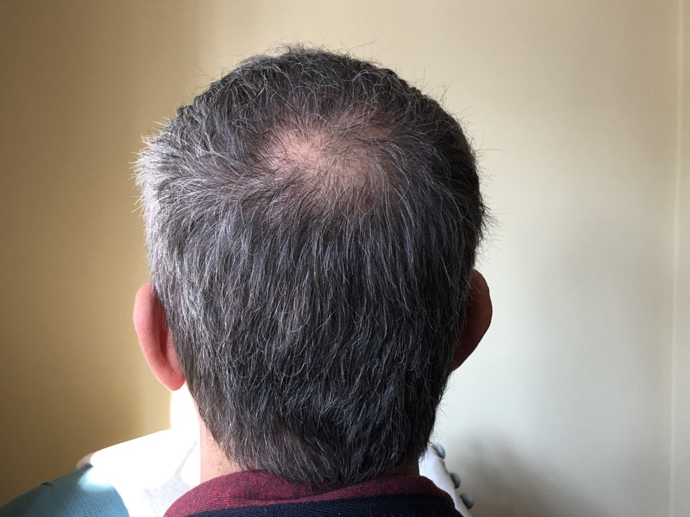 5.5months post & after 2nd Haircut  3122.JPG