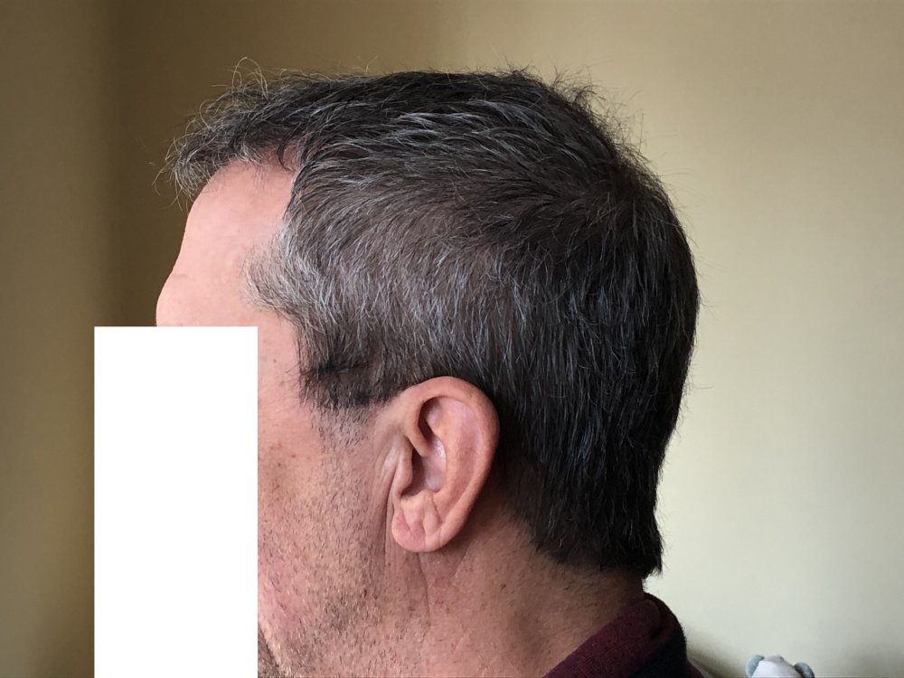 5.5months post & after 2nd Haircut 3123.JPG