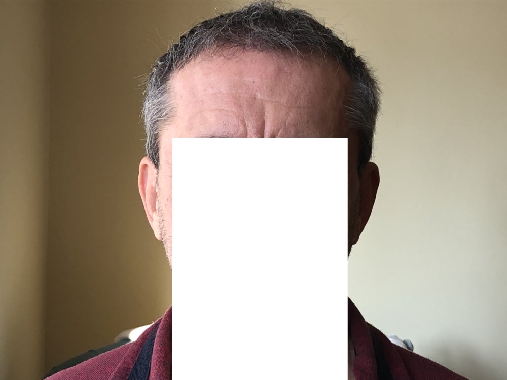 5.5months post & after 2nd Haircut 3124.JPG