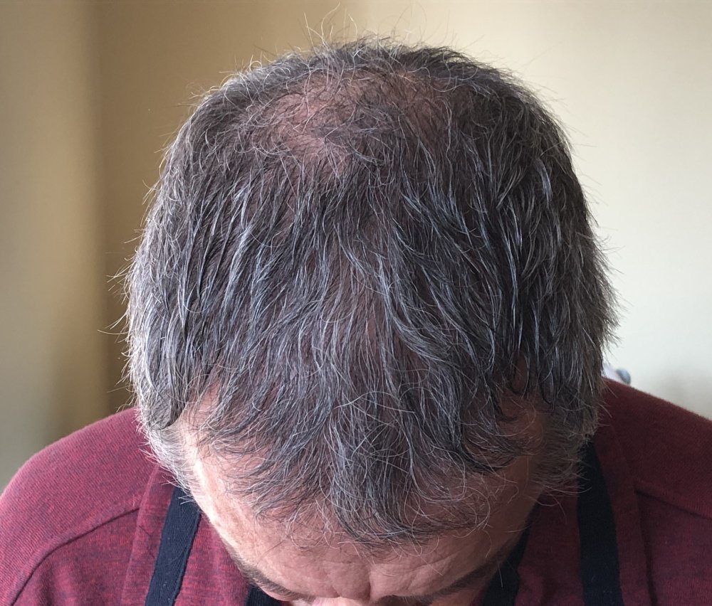 5.5months post & after 2nd Haircut 3125.JPG