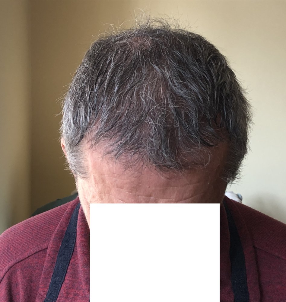 5.5months post & after 2nd Haircut 3127.JPG