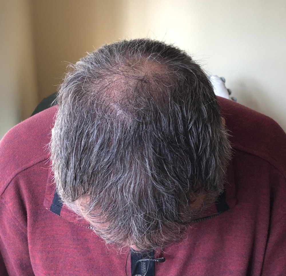 5.5months post & after 2nd Haircut 3128.JPG
