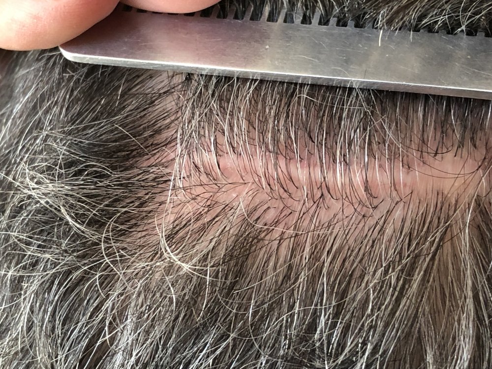 5.5months post & after 2nd Haircut 3132 - left side.JPG
