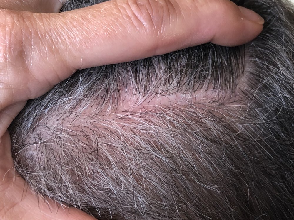 5.5months post & after 2nd Haircut 3136 - right side.JPG