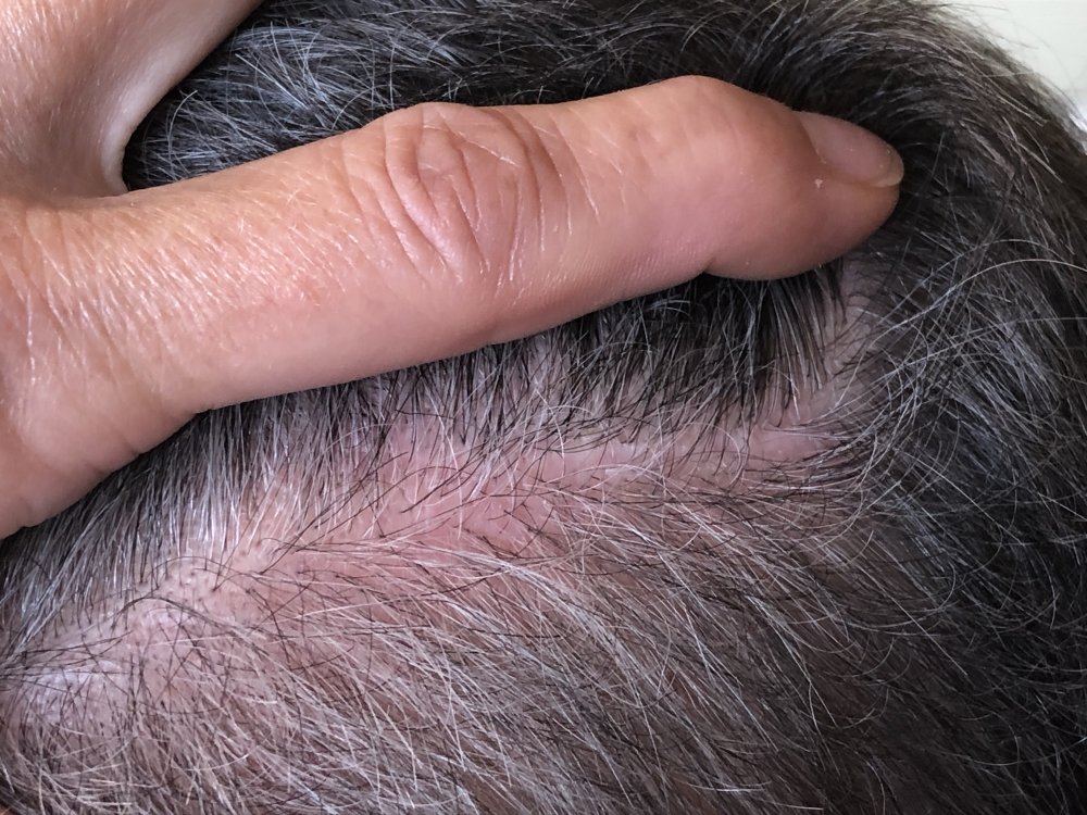 5.5months post & after 2nd Haircut 3137 - right side.JPG
