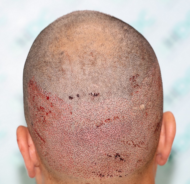 5. Back Donor, immediately post op.JPG