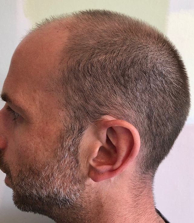 5. Before side donor.jpg