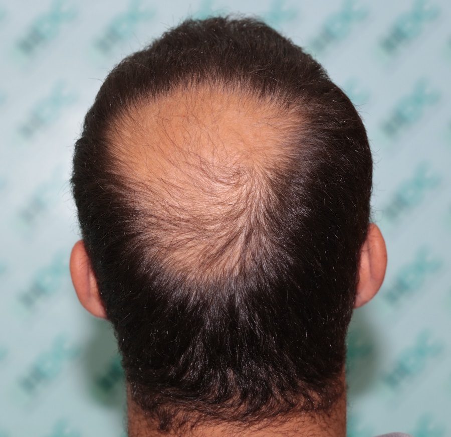 5. Crown Before FUE2.JPG