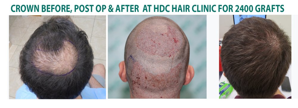 5. Crown result with post op 2400 grafts.jpg