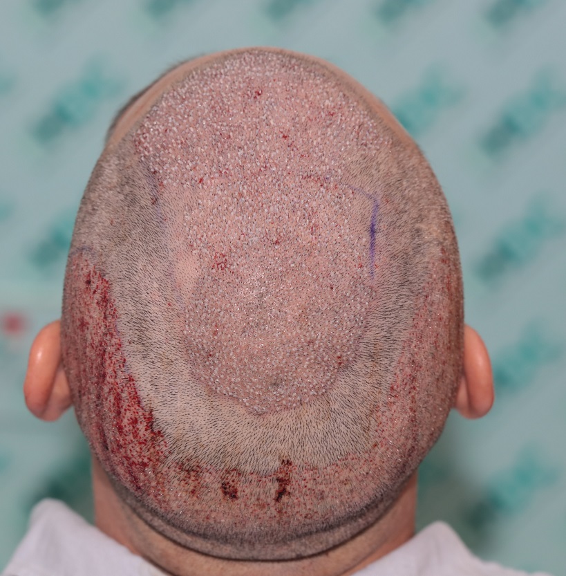 5. crown view post op.JPG