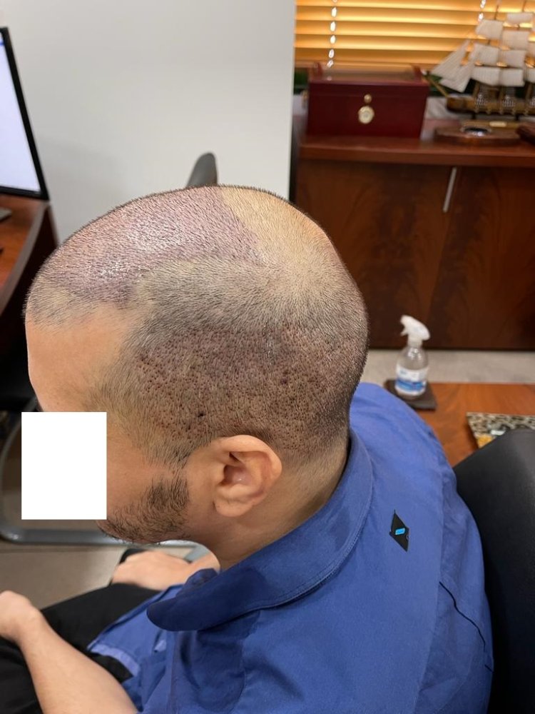 5 days after left side.jpg