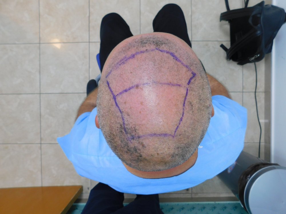 5. Design FUE2 Top Back.JPG