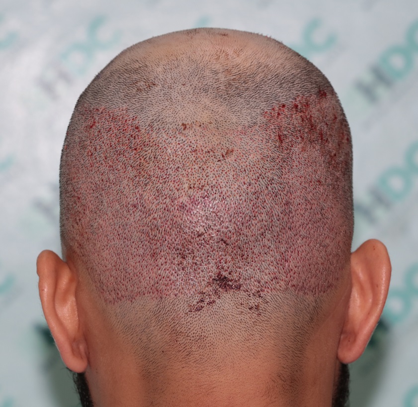 5. Donor Post op.JPG