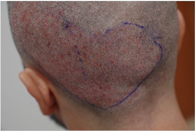 5. Donor right after 1st surgery.jpg